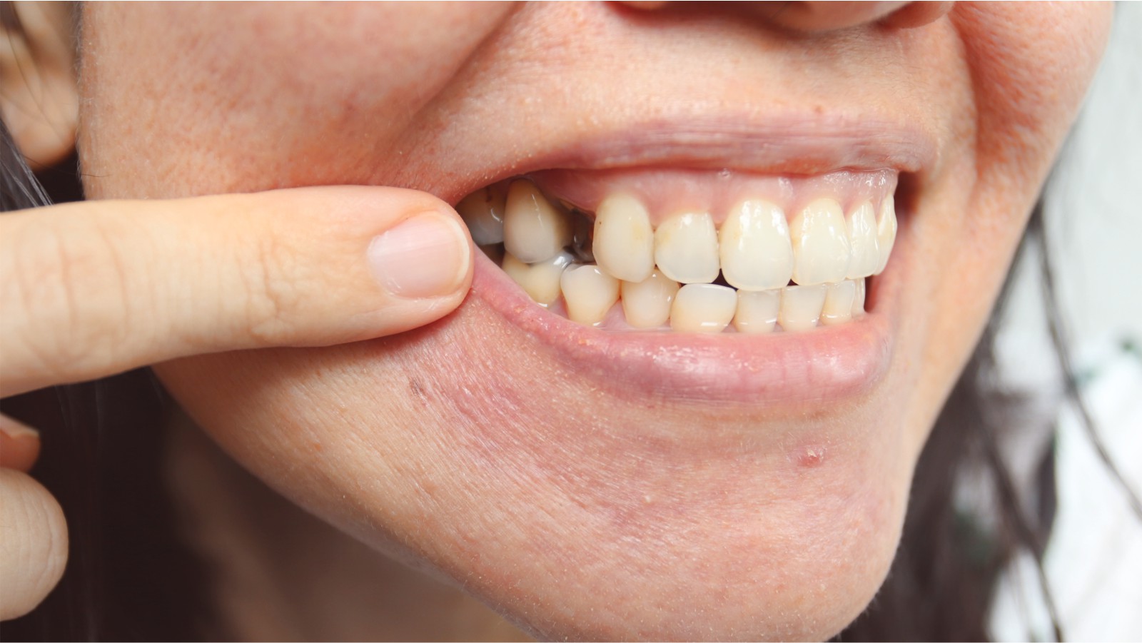 Agenèsia dental. Què és, causes, conseqüències i tractaments