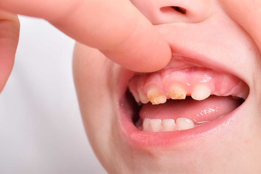 La càries del biberó: una malaltia dental freqüent en la primera infància