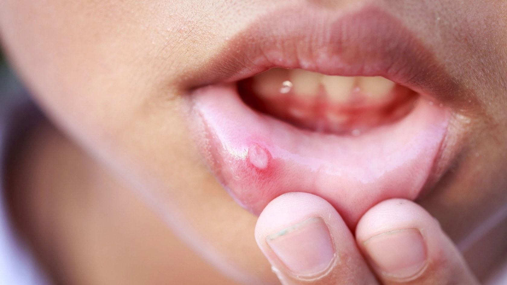 Mucocele. Què és, per què apareix i com es tracta