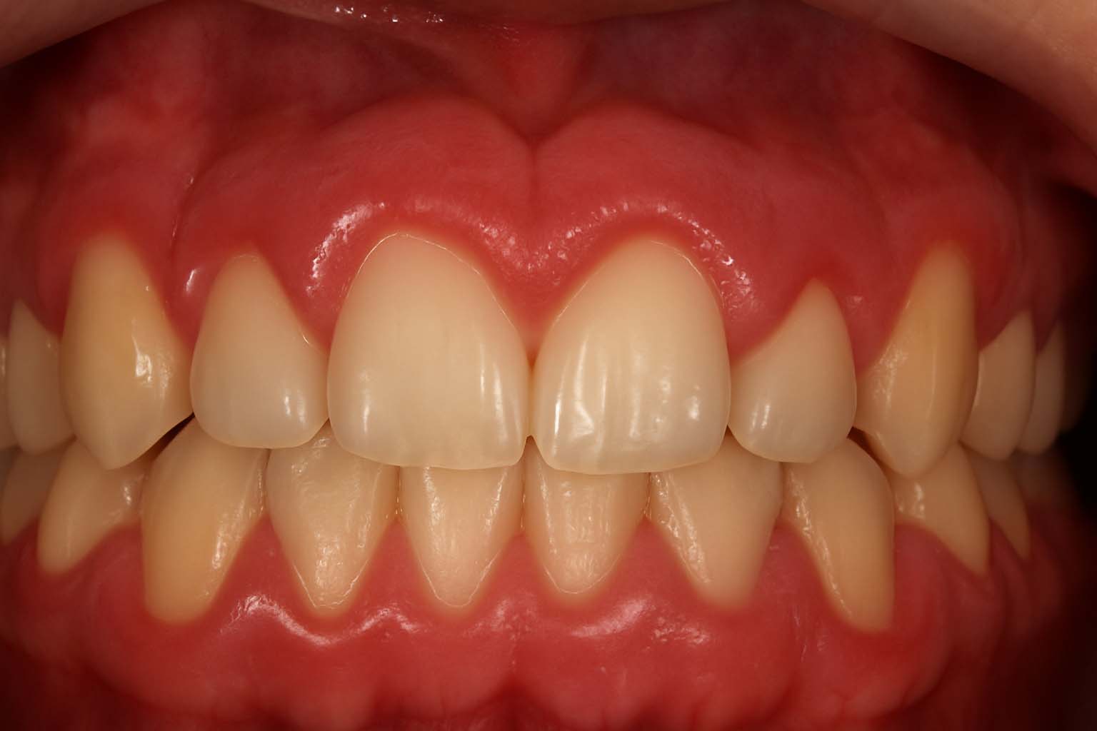 Hiperplàsia gingival. Què és, per què apareix i com es tracta