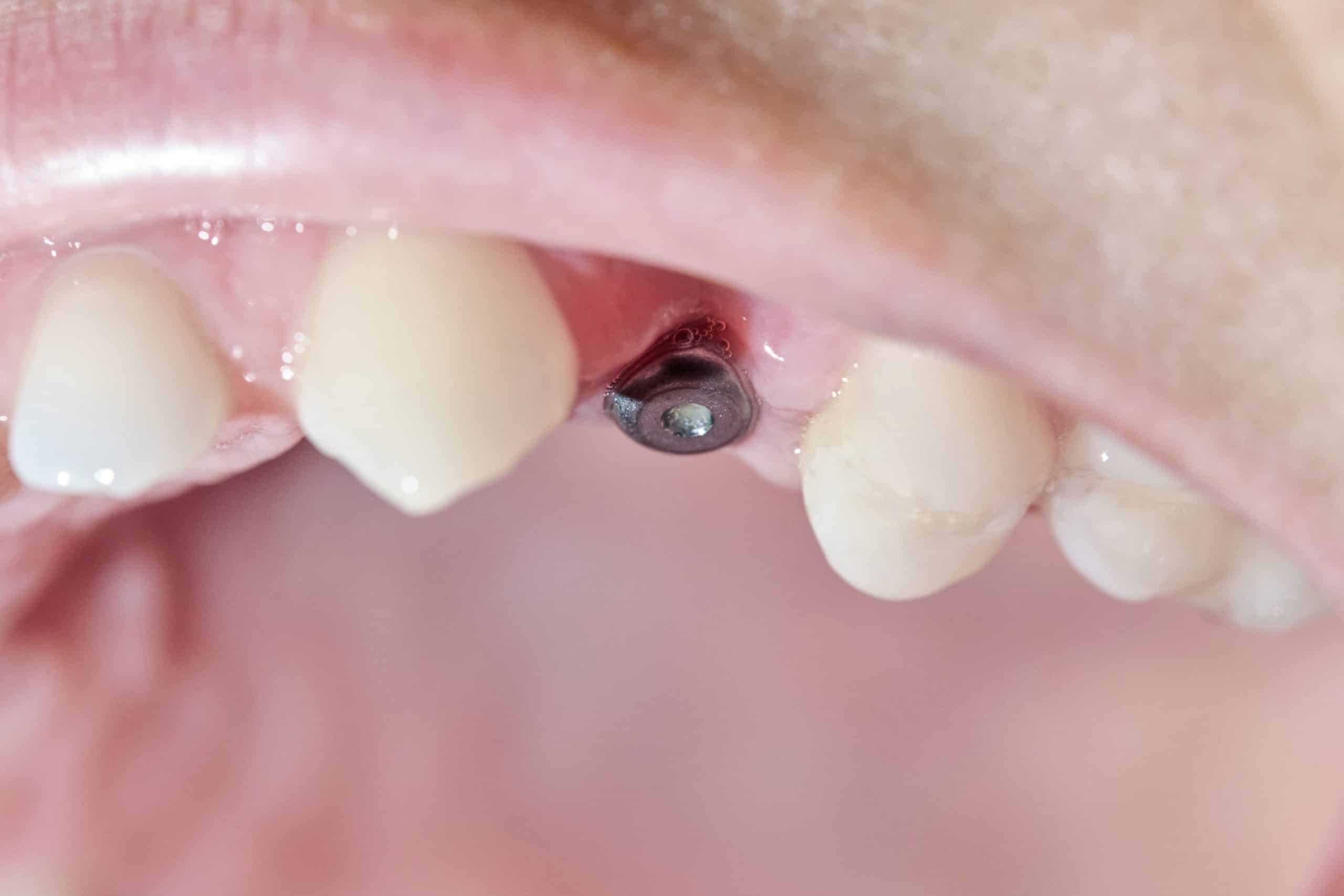 Què són els implants dentals i com funcionen