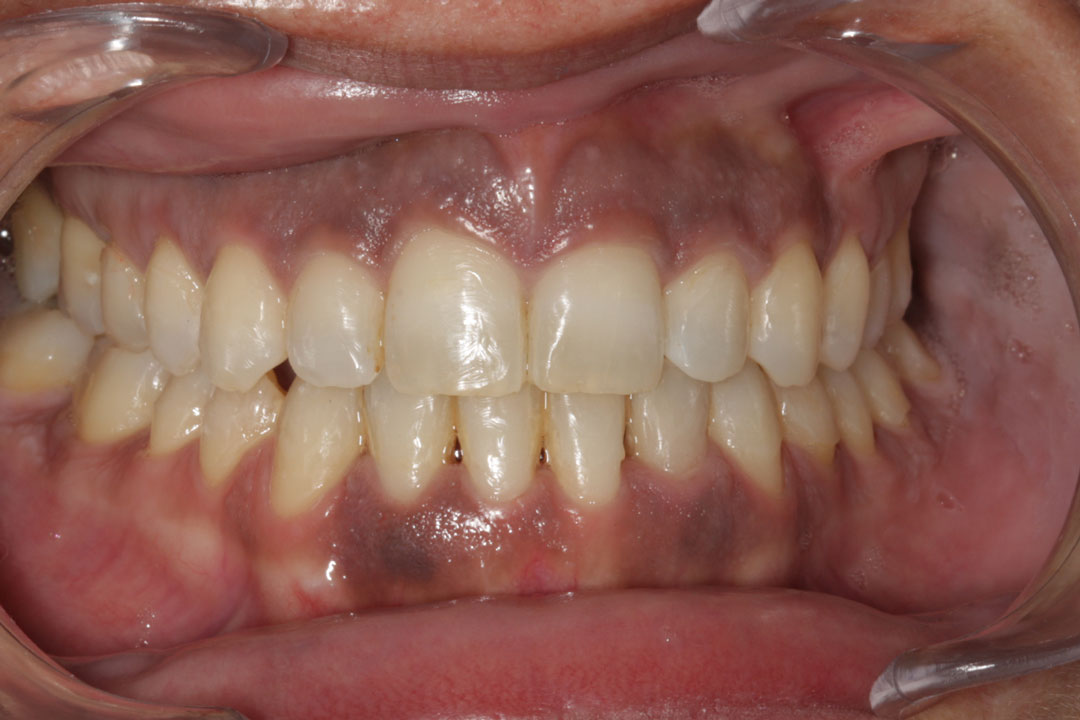 Melanosi oral. Què és, causes i quan cal preocupar-se