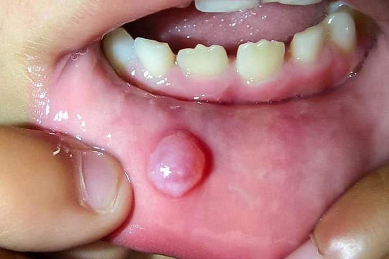 Mucocele. Què és, per què apareix i com es tracta