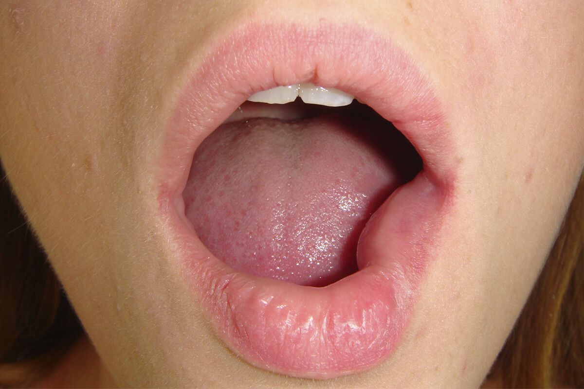 Mucocele. Què és, per què apareix i com es tracta
