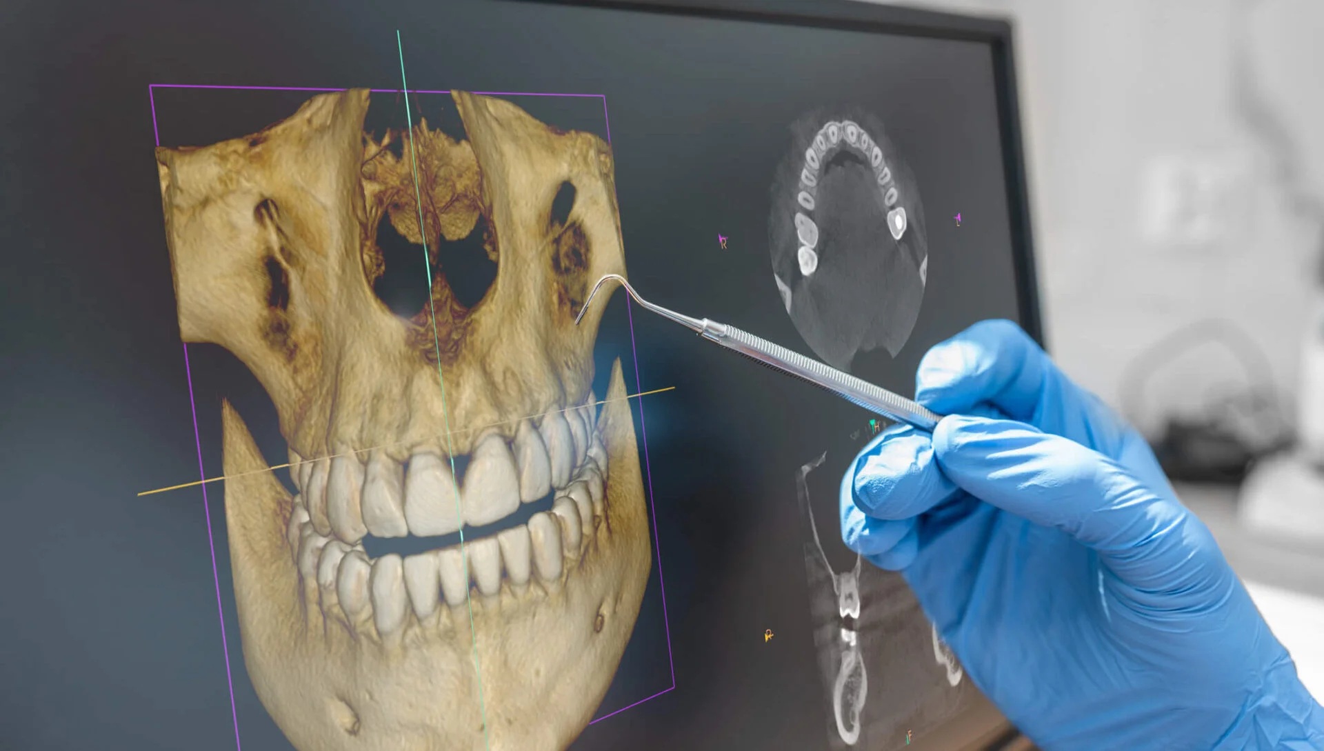 Pèrdua d’os al maxil·lar. Què és i per què passa?