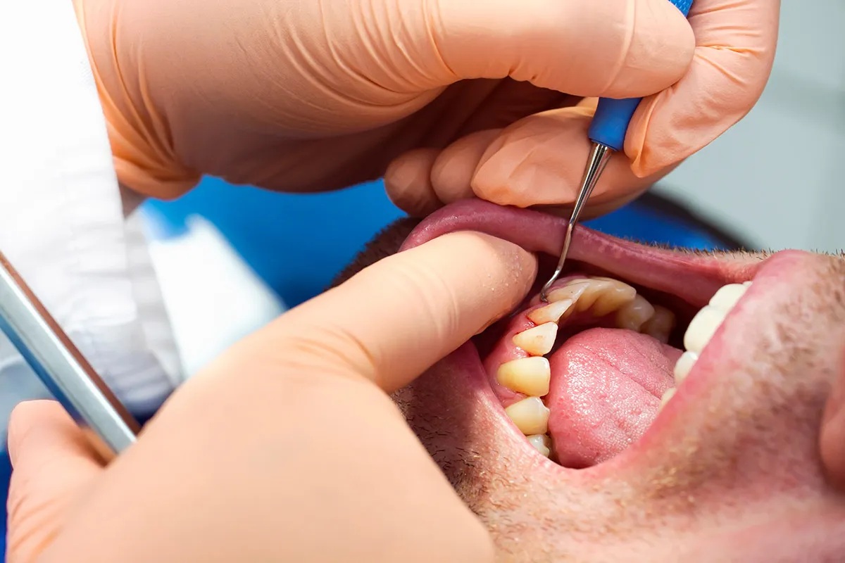 Relació entre la periodontitis i les malalties cardiovasculars